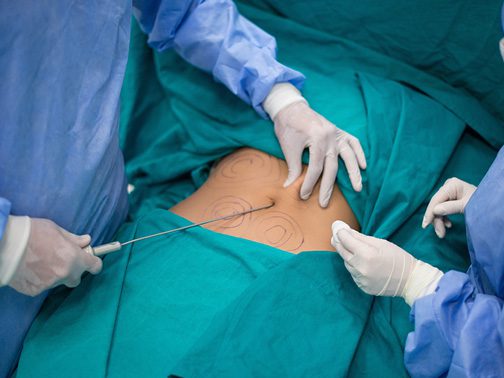 liposuccion 3