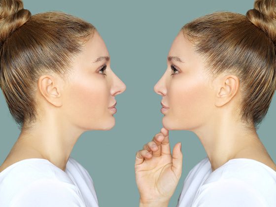Recuperación de rinoplastia — timeline semana a semana con la Dra. Ma. Isabel Caravantes