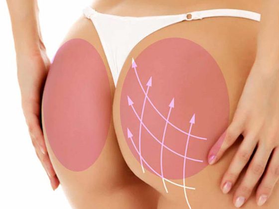 cual es la forma de los implantes de gluteo 2