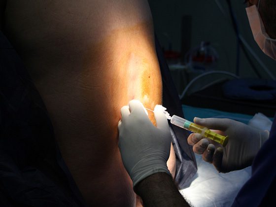 que tipo de anestesia se utiliza para la cirugia de protesis de pantorrilla 1