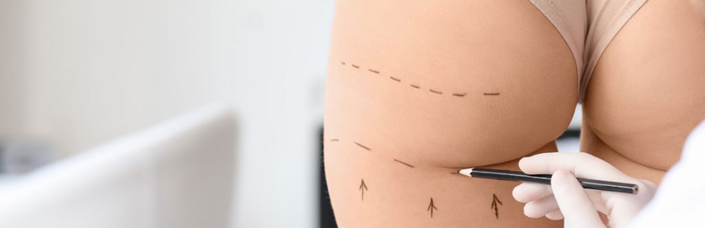 se pueden hacer procedimientos combinados de colocar implantes para gluteo y aplicar grasa 1