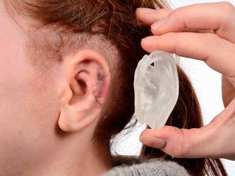 Reconstruccion de oreja lesionada 2