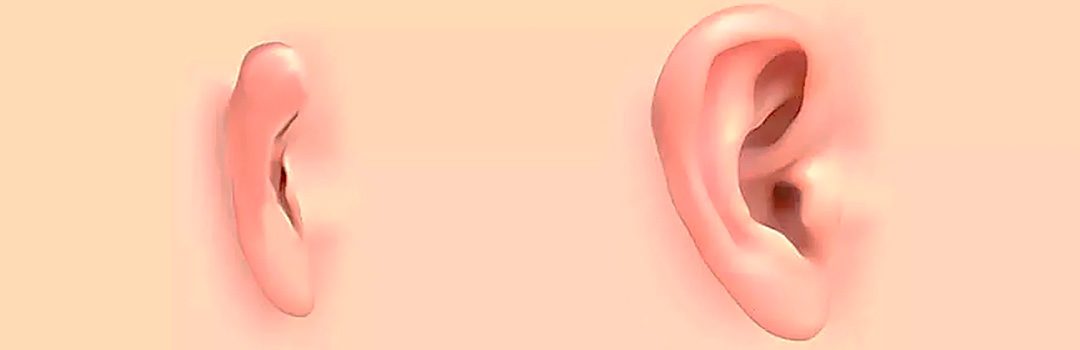 alteracion congenita de la oreja 4