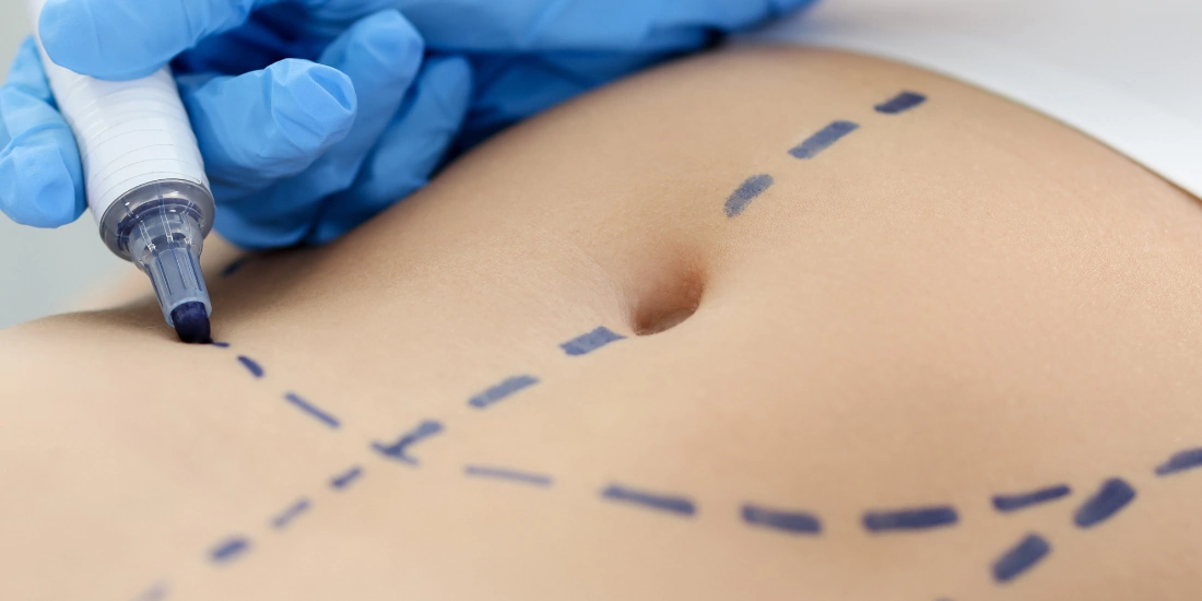 Lipectomía — zonas de tratamiento abdominal | Imagen ilustrativa