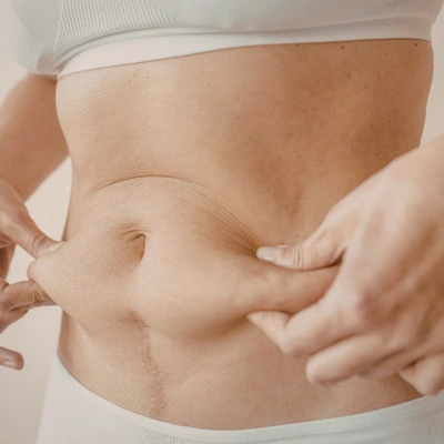 Grasa localizada abdominal resistente a dieta y ejercicio